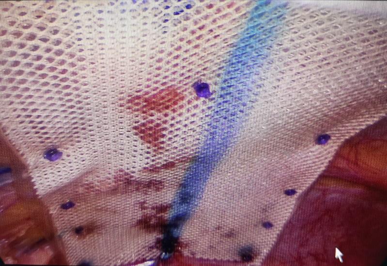 腹部手术后如何预防切口疝,腹部疝气手术并发症