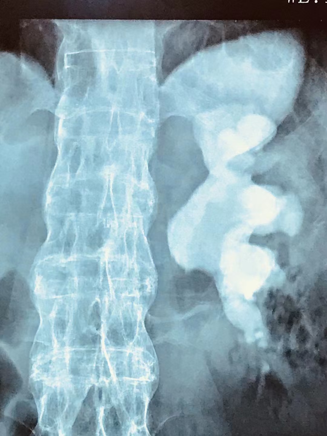 已经血尿了还在“吃药排石”，是不是撞了南墙才会回头呢？