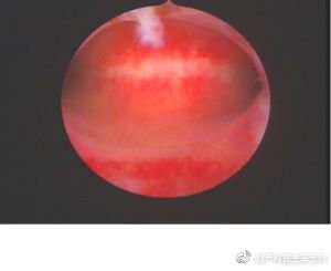 输卵管通而不畅通过腹腔镜咋检查,左侧输卵管通畅右侧通而不畅