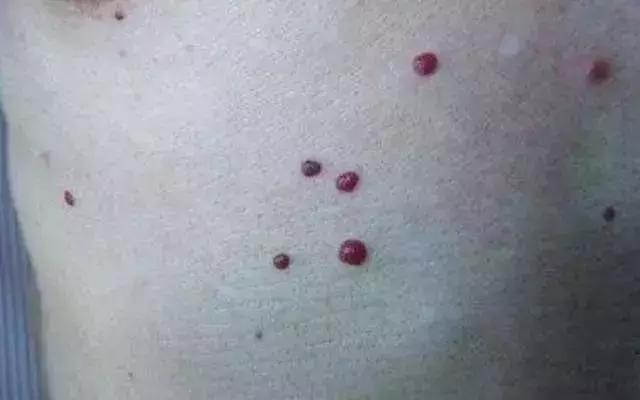 39岁男子查出肝癌,35岁男子查出肝癌身上有特殊记号