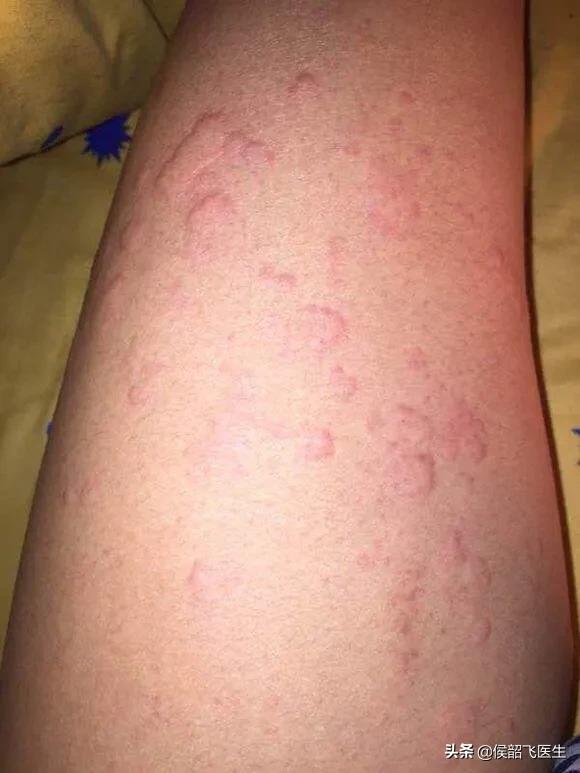 地塞米松护理口诀,侯医生讲座视频