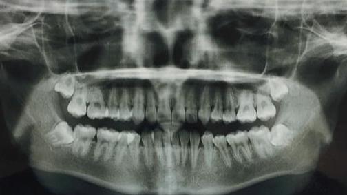 阻生智齿完全埋在牙龈里,牙龈下面的阻生智齿需要拔么