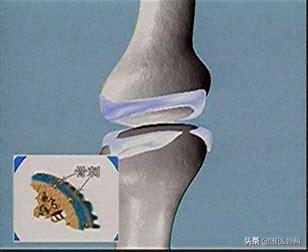 骨刺和骨性关节炎哪个更严重,骨刺也是骨性关节炎吗