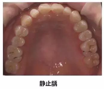 牙齿正面有小黑点千万不要忽视,不要小看牙齿的小黑点