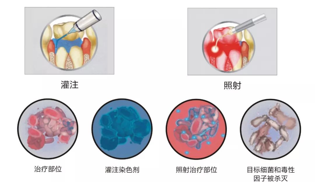 口腔治疗新技术—《哌威光动力口腔治疗系统》