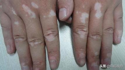 脚冻疮对白癜风有影响吗,白癜风冻疮
