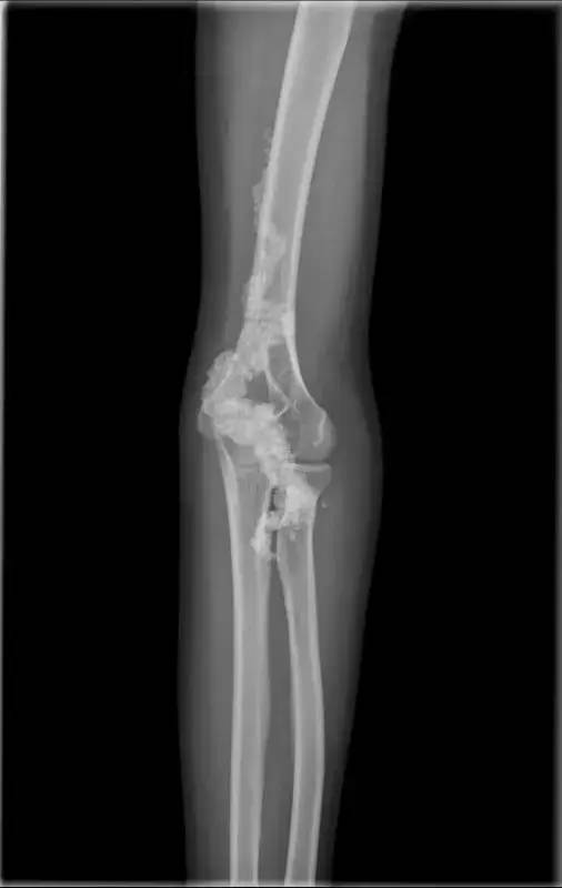 钙质沉着症全国有多少例,钙质沉着症是什么意思