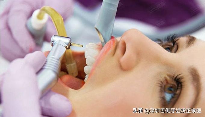 洗牙后牙齿变敏感怎么办,洗牙两周牙齿出血敏感