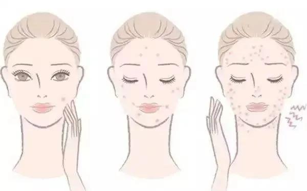 祛痘和祛痘印的方法一样吗,祛痘和祛痘印最好的方法是什么