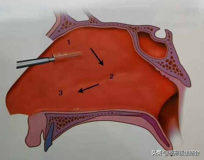 鼻整形手术风险,鼻整形副作用