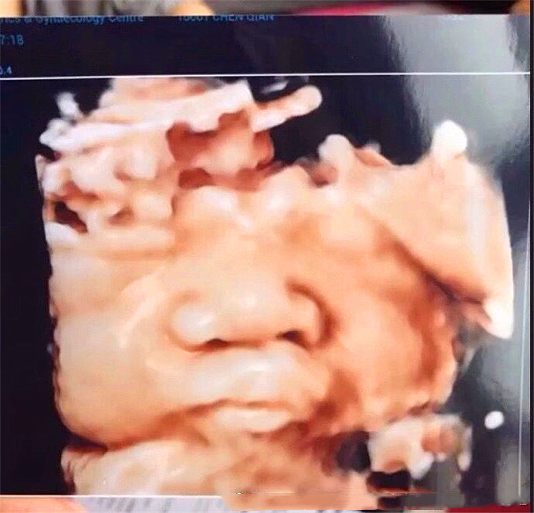 拍彩超胎儿嘴歪,怀孕四维看到孩子嘴歪