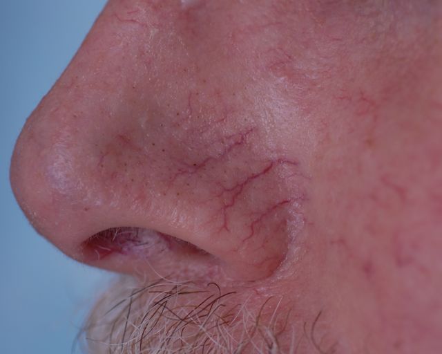 腿上有蜘蛛网是怎么回事,腿上结蜘蛛网是什么