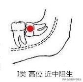 智齿分轻重嘛,智齿水平和非水平的区别