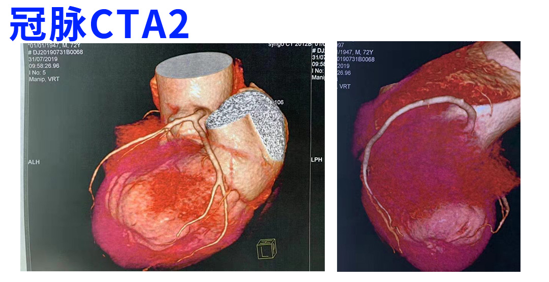 冠脉没有狭窄是否排除心肌缺血,冠脉不堵塞却心肌缺血怎么治疗