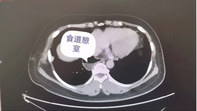 盘江总医院成功开展首例食管憩室切除+食管重建术