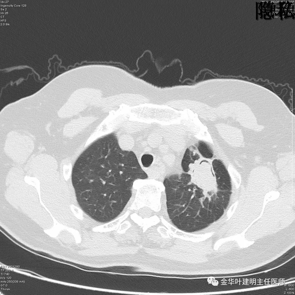 左肺下叶恶性病变,左肺上叶和下叶都有血管畸形