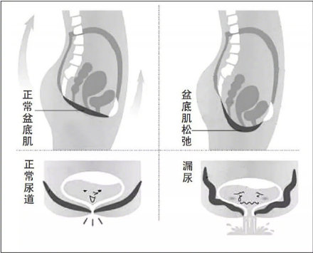 成年半夜尿裤子是什么情况,尿裤子中医怎么治疗