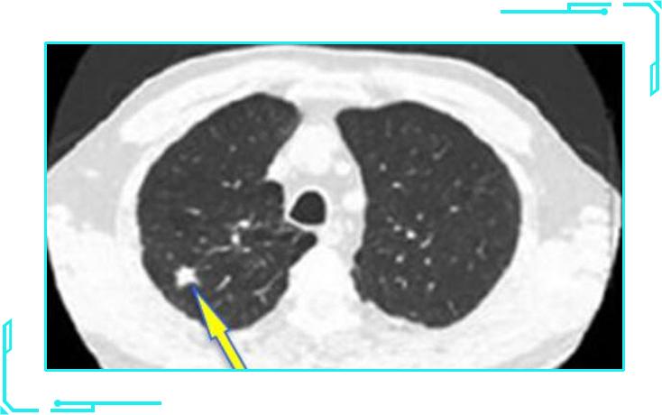 肺结节7mm需要做肺癌抗体7项,肺结节高危与早期肺癌的区别