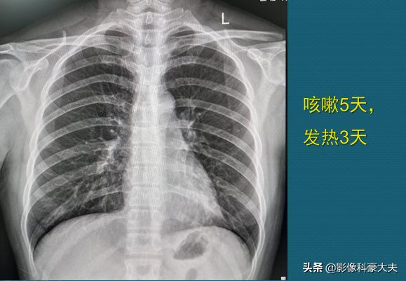 1场支原体肺炎，我拉黑了学理科的女同学