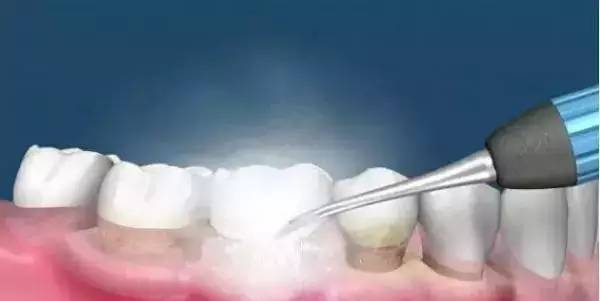 洗牙到底怎么洗好,洗牙洗的不干净