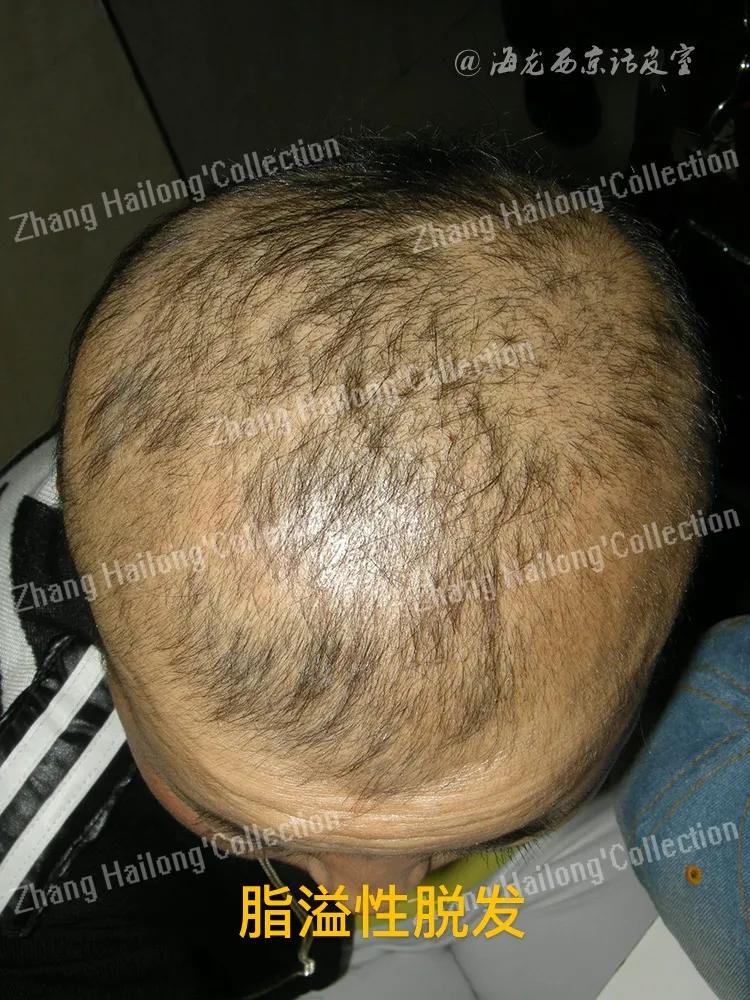 脂溢性脱发还能生发吗,脂溢性脱发吃维生素几