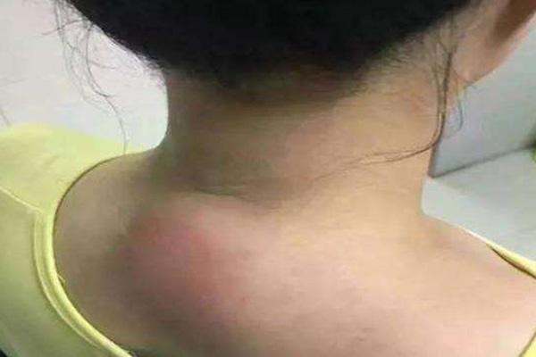 怎样锻炼消除脖子后面的富贵包,后背脖子上长了富贵包怎么回事