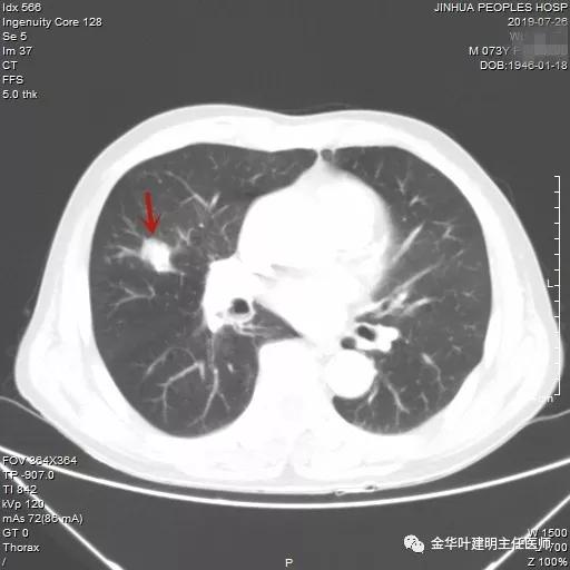 能不能手术,极重度混合性通气功能障碍能治吗