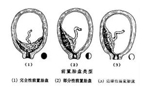 试管婴儿双胞胎有风险吗,试管婴儿产妇风险