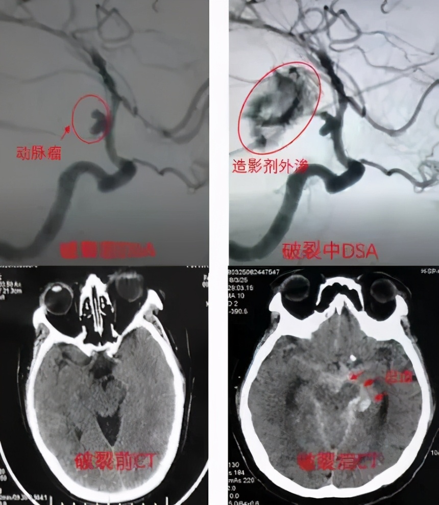 爆炸性头痛,爆炸性神经性头痛