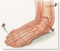 治疗扁平足,聊聊足弓塌陷