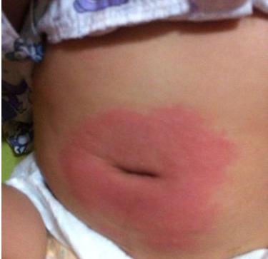 新生儿肚脐眼出血如何消毒,新生儿肚脐眼碘伏消毒出血了