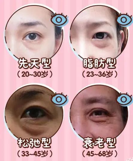 眼袋泪沟黑眼圈卧蚕是怎么形成的,如何分清楚卧蚕泪沟眼袋黑眼圈