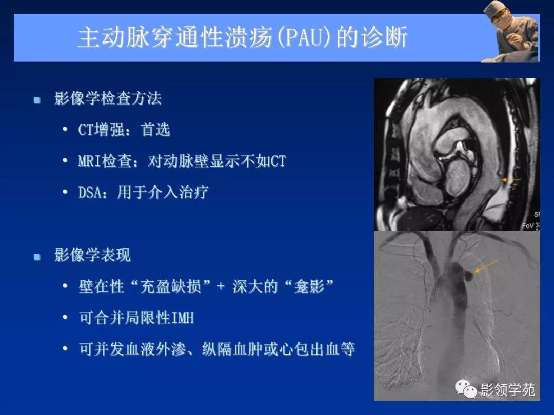 主动脉夹层壁间血肿如何鉴别,主动脉夹层血肿溃疡