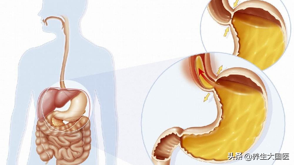 被忽略的“反酸”、“烧心”，可能是要命的潜在疾病，这2类人尤其应注意