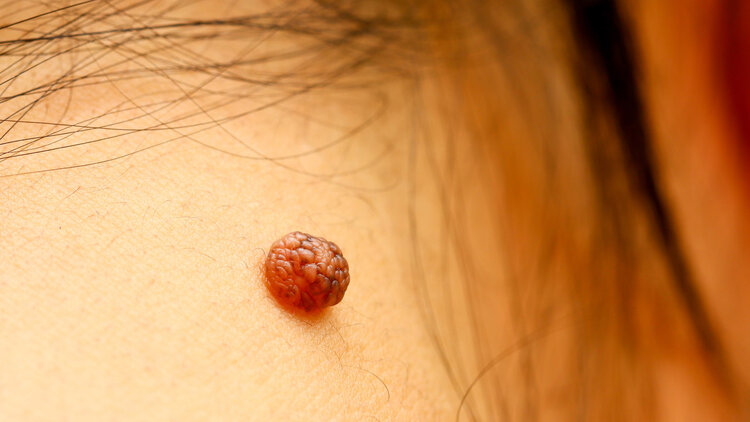 再次提醒黑痣长在这3个部位,长这三种痣可能和癌症有关