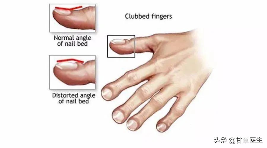 指甲的哪些变化需警惕疾病风险,指甲上有竖条纹是哪些疾病的征兆