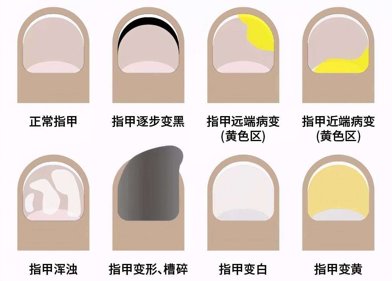 如何从指甲看出自己的健康状况,真正的健康真相你知道吗