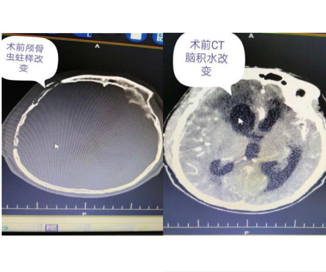 神经外科脑积水,沈北中心医院外科