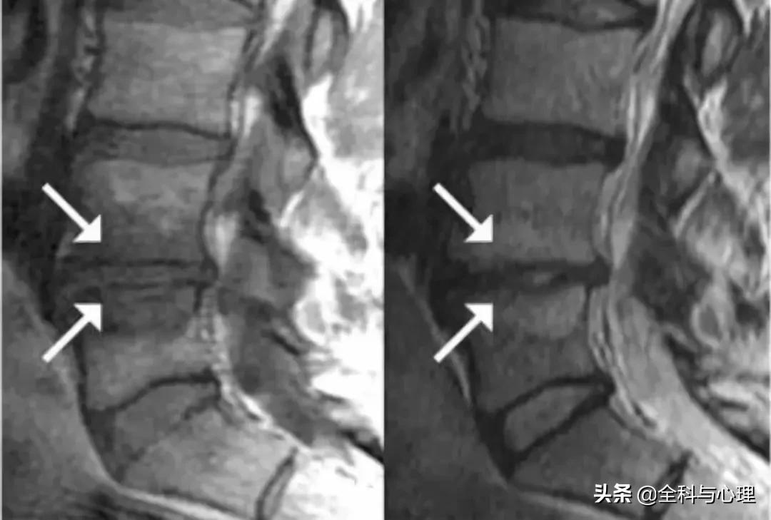 腰痛要警惕四种原因肾不好,盘点腰痛常见病因及防治训练