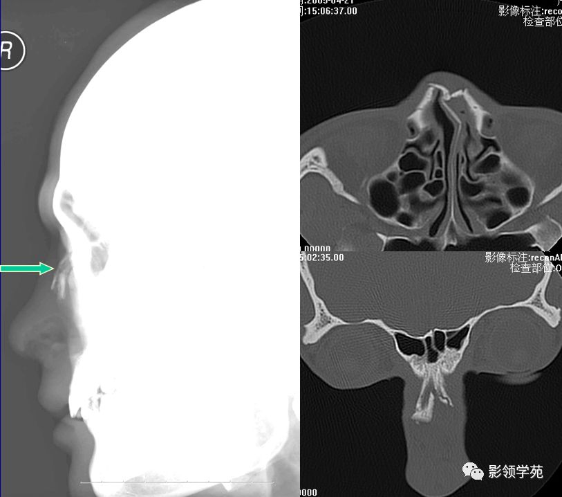鼻骨骨折的检查方法,鼻骨骨折影像学表现