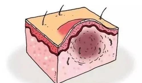 头皮长痘痘怎么办碰了痛,头皮长痘痘怎么办最有效的方法