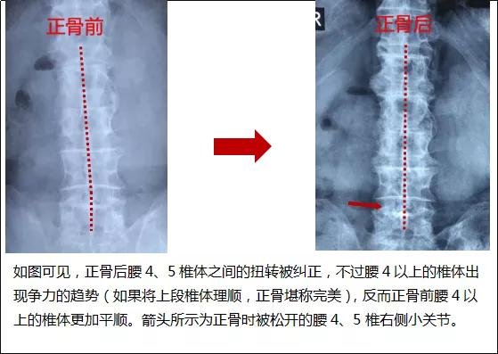 骨头不正会怎么样,老人骨头僵硬坐不稳