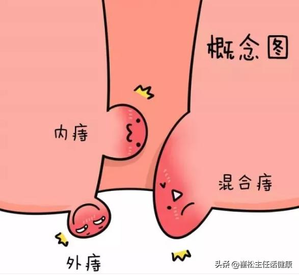 大便出血疼痛是癌症吗,直肠癌和痔疮大便出血的区别