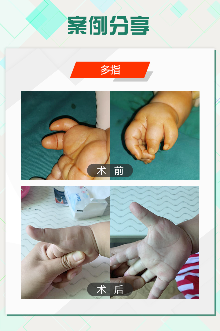 手足外科陈江海微博,手外科专家陈江海