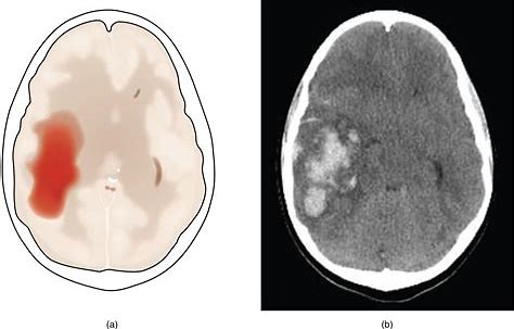 高血压能不能引起高颅压,高血压吃哪种药降低颅压