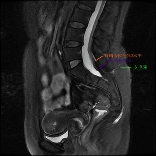 脊髓栓系综合征如何缓解,做了脊髓栓系综合征会有后遗症吗