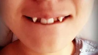 牙齿拥挤9个月变化图,牙齿拥挤排齐后嘴会凸吗