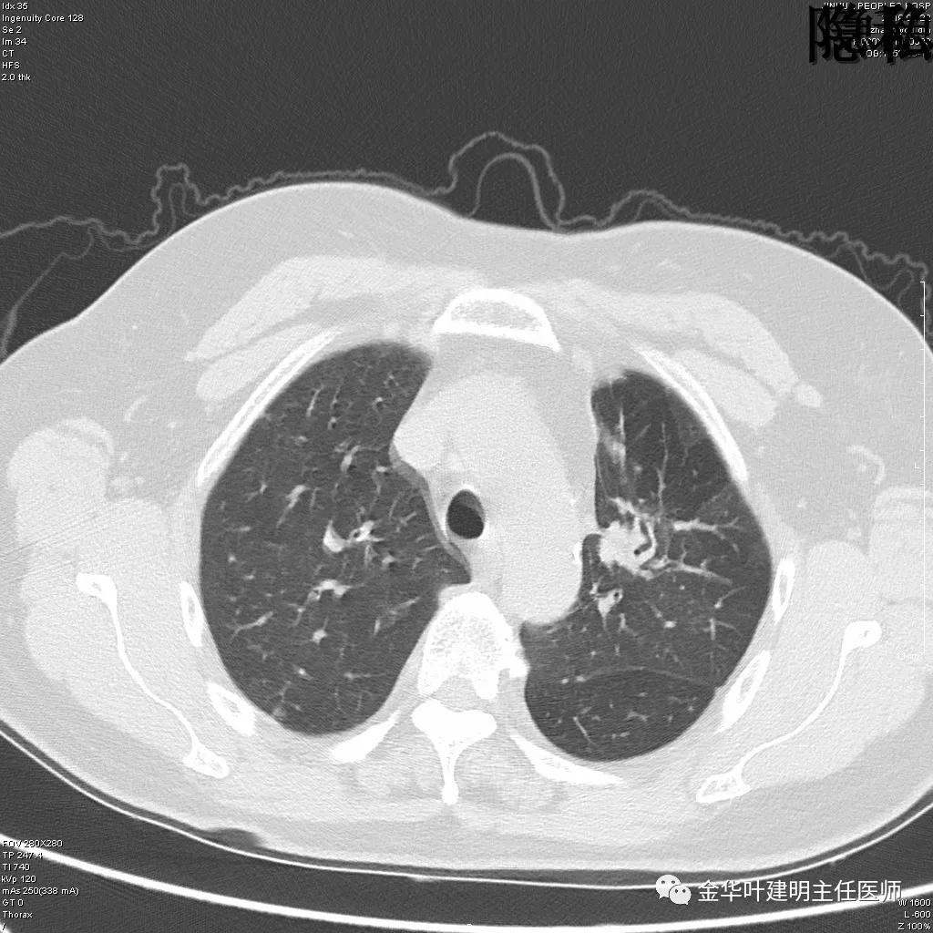 左肺下叶恶性病变,左肺上叶和下叶都有血管畸形