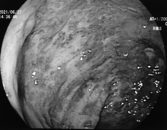 南大二附院消化内科谢正元教授团队完成院内首例内镜下弥漫性直肠静脉畸形扩张出血硬化剂注射止血术