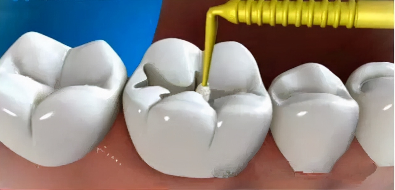 牙齿烂了一大半不补可以吗,牙齿全部烂了能不做牙冠吗